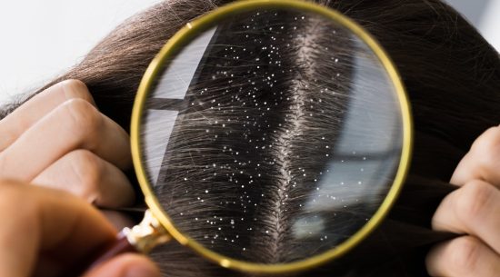 How to Get Rid of Dandruff?
